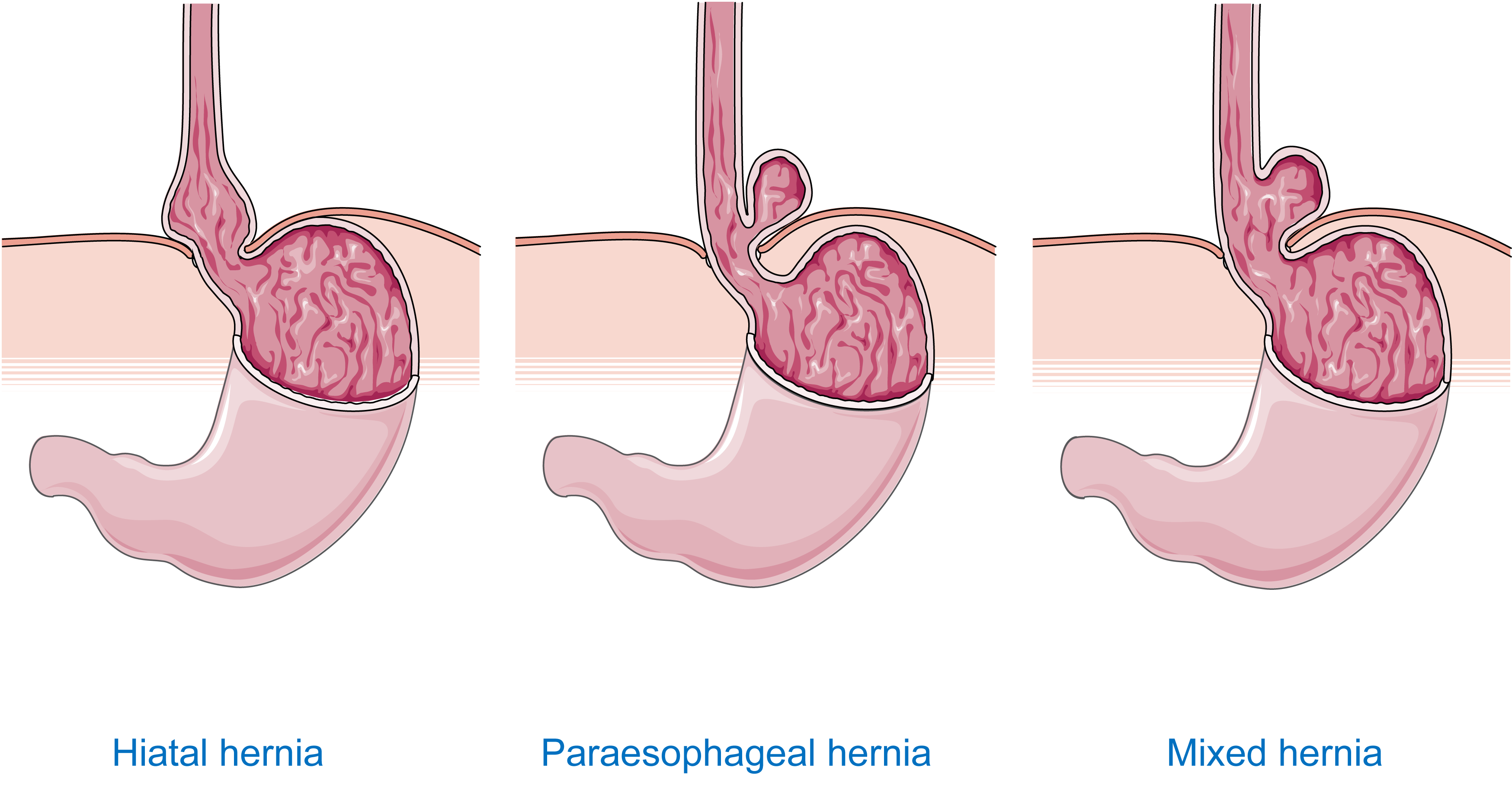 Servier Drawing Hiatal hernia of stomach no labels AnatomyTOOL